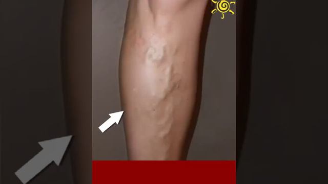 Improve varicose veins, reduce dry lines and blood streaks