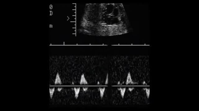 16. Фиброэластоз эндокарда у плода смотреть онлайн