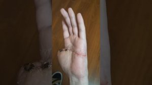 травма кисти и разрыв сгибателя пальца