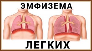 ЭМФИЗЕМА ЛЕГКИХ - ПРИЧИНЫ СИМПТОМЫ ЛЕЧЕНИЕ