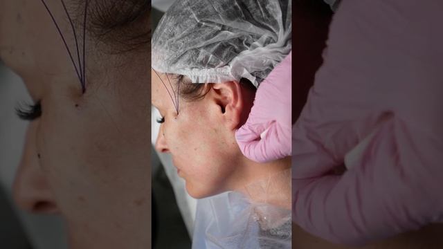 Barb Spiral. Строение мезонити. Для каких пациентов. Какие эстетические недостатки корректируют смотреть онлайн