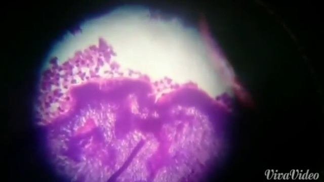 Actinomycosis (magnified)
