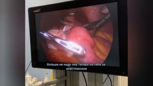 Минигастрошунтирование пациентке с ИМТ 52 и очень большим животом