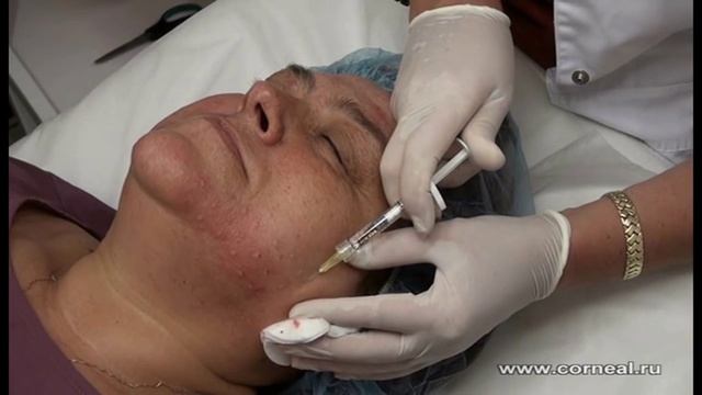 Липолитики - лучше роллер или мезотерапия? смотреть онлайн