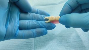 протезирование зубов