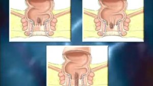 Лечение геморроя лазером, инфракрасным коагулятором