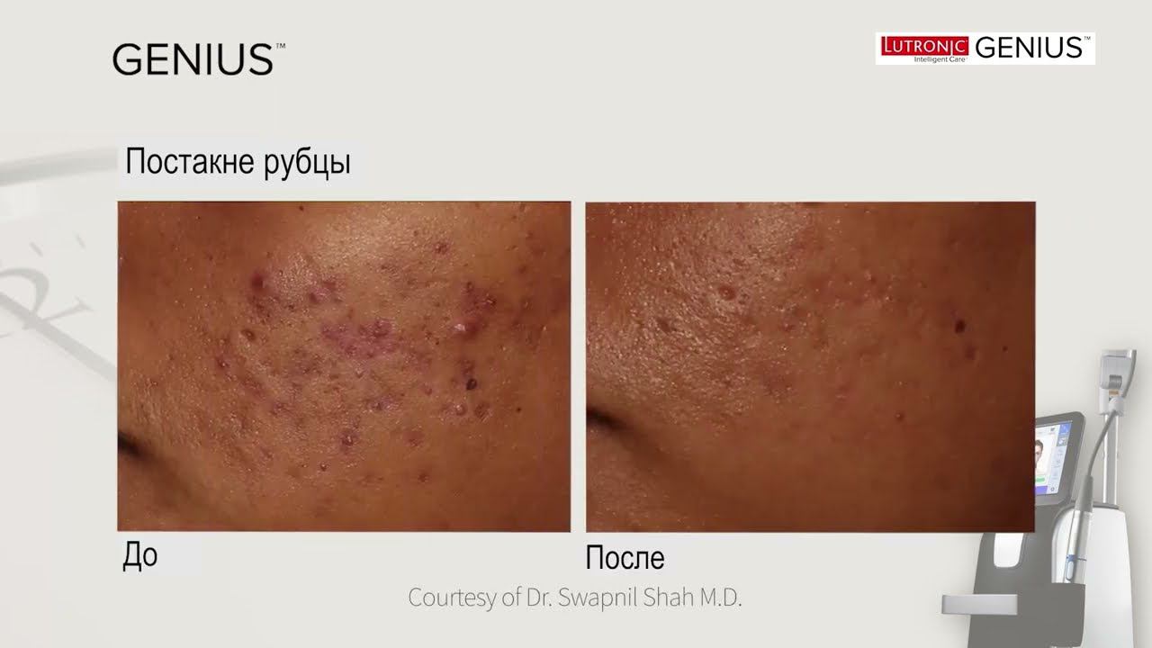 Lutronic Genius – выбор тех, кому нужен результат смотреть онлайн