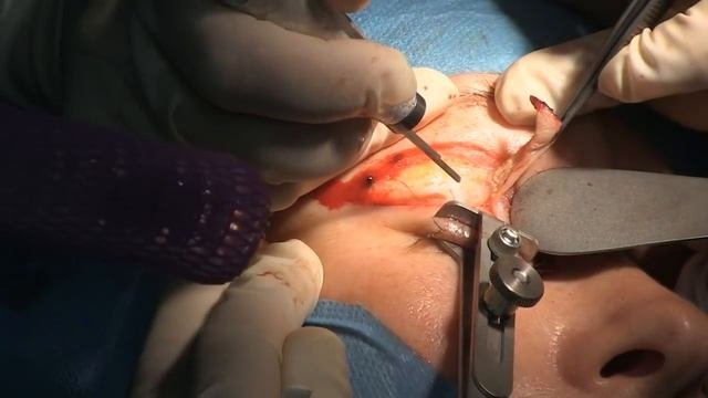 Проведение блефаропластики с помощью СО2-лазера.