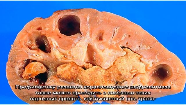 Коралловидные камни в почках