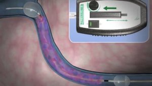 Тромболизис