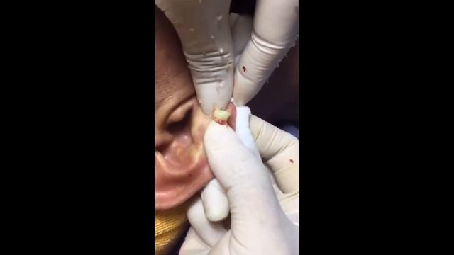 большой прыщ, прыщи, гнойник, выдавливание прыщей, как выдавить прыщи смотреть онлайн