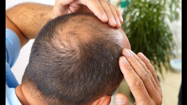 Как Мужчине восстановить волосы смотреть онлайн