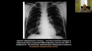 Туберкулез и ВИЧ-инфекция