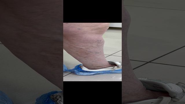 Вылечили флебит. Продолжаем лечить тромбоз. Варикоз. Флеболог Москва. Флеболог. Сосудистый хирург смотреть онлайн