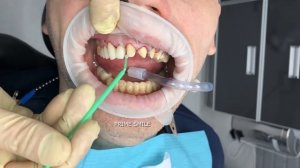 Керамические виниры Emax + коронки на основе диоксида циркония с опорой на имплантат.