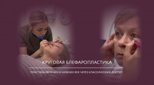 Круговая блефаропластика: пластика верхних и нижних век