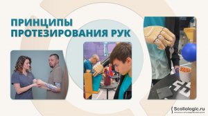 Принципы протезирования верхних конечностей в Scoliologic.ru
