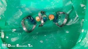 Клампы B4 фронтальный участок без якорных клампов, преэндодонтический билдап DET.expert & Sanctuary