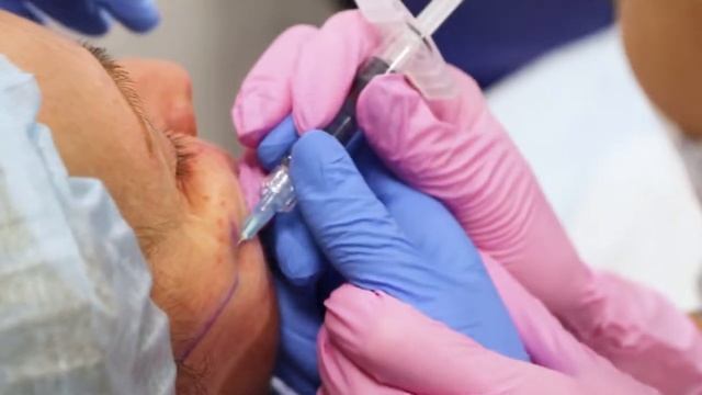 Увеличение скул и увеличение губ филлером с гиалуроновой кислотой Repleri смотреть онлайн