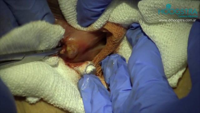 Resección de quiste en glándula bartolina (19011) смотреть онлайн