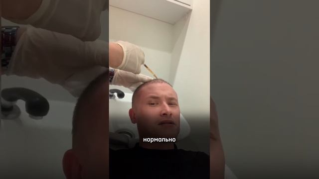 Пересадка волос в Турции. Часть-6 (Плазмотерапия между 3 и 4 месяцем) смотреть онлайн