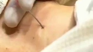 Техника катетеризации внутренней яремной вены