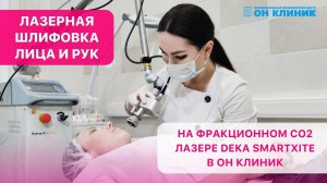 Лазерная шлифовка лица и рук на фракционном СО2 лазере Deka SmartXide в ОН КЛИНИК