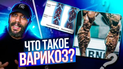 ВАРИКОЗ - ПРИЧИНЫ, ЛЕЧЕНИЕ, ПРОФИЛАКТИКА