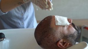 Cпособ мытья после пересадки волос