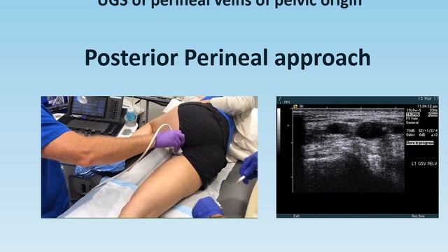 Ultrasound-guided perineal foam sclerotherapy - Société Française de Phlébologie
