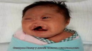 Синдром Патау у детей: кариотип, симптомы, признаки, причины, лечение, фото новорожденных. Синдром.