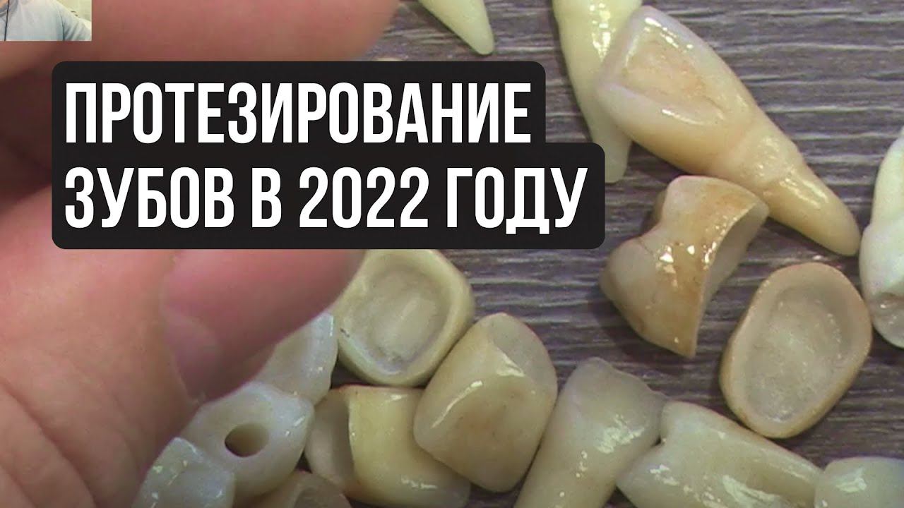 Металлокерамика: протезирование – актуально? Протезирование зубов в 2022 году