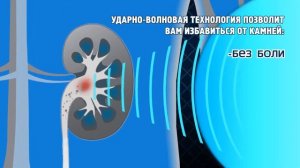 Процедура дробления камня в почке