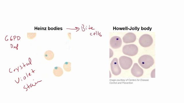 USMLE RX - 5.Гематология и онкология - 2.Патология - 4.Иные аномалии эритроцитов