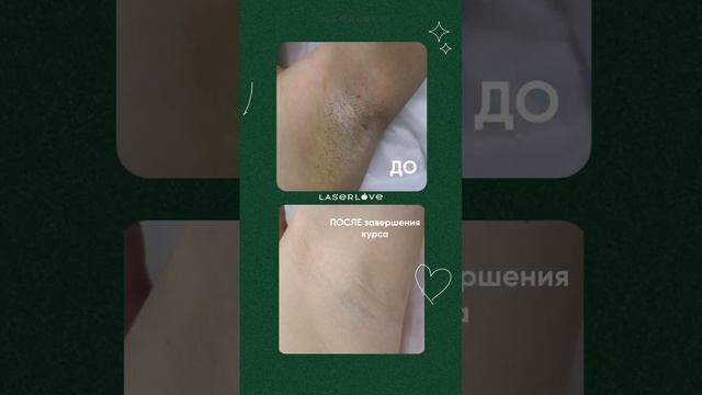 Лазерная эпиляция ДО и После смотреть онлайн