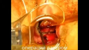 Ножевая и лазерная конизация