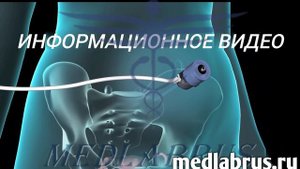 Лапароскопия. Перевязывание маточных труб