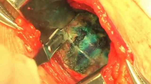 Хирургическое лечение п-тов с остеохондрозом шейного и поясничного отделов (ГБ N1, г.Новокузнецк) смотреть онлайн