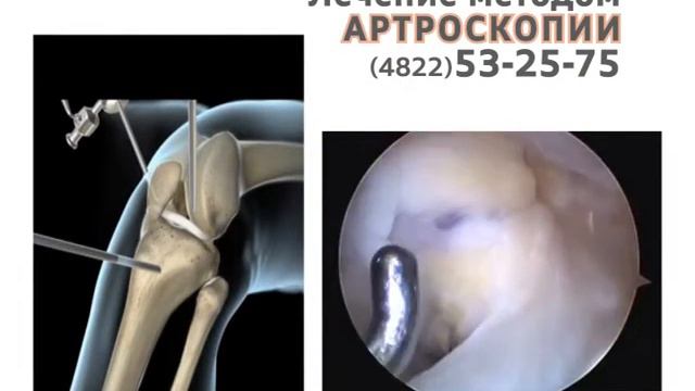 Артроскопия смотреть онлайн