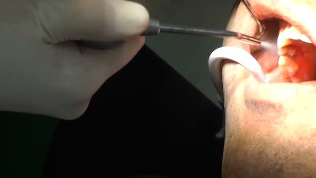 Чистка зубного камня весь процесс за 30 секунд! смотреть онлайн