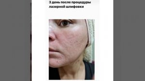 Лазерная шлифовка. Восстановление по дням.