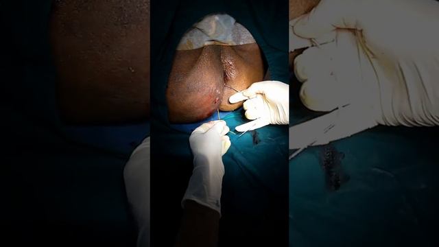 Fistula In Ano Surgery | Ksharsutra | Bhagandar | Anal Fistula Operation | Bangladesh | Agartala