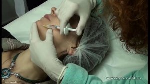 Учимся делать биоревитализацию