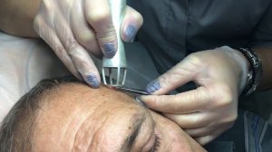 Лазерное удаление кожного рога