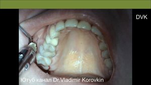 Инфильтрационная анестезия для лечения 16 зуба.#infiltration #anaesthesia