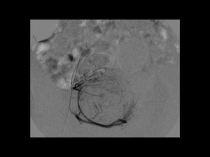 Subtraction angiography