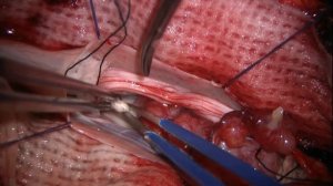 Невринома/ spinal neuroma