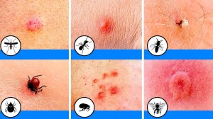 10 Укусов Насекомых, Которые Нужно уметь Распознавать