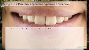 Как сделать искусственные брекеты