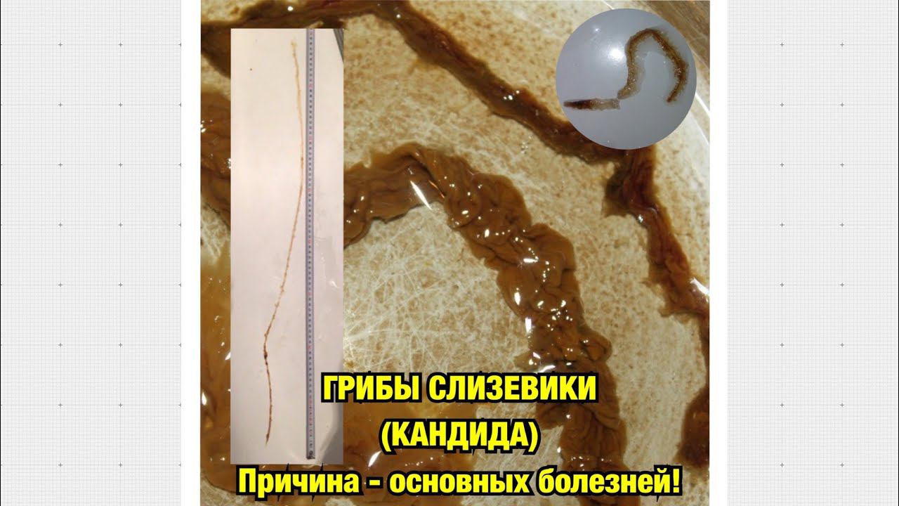 ПРИЧИНА ОСНОВНЫХ БОЛЕЗНЕЙ - ГРИБЫ СЛИЗЕВИКИ, КАНДИДА! ГРЕХИ И БОЛЕЗНИ! ОБУЧЕНИЕ В СТОПАПТЕКЕ - 15